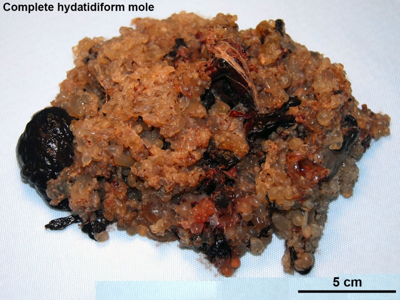 File:Complete hydatidiform mole 05.jpg