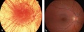 Comparison between fundus in Albinism and Normal eye