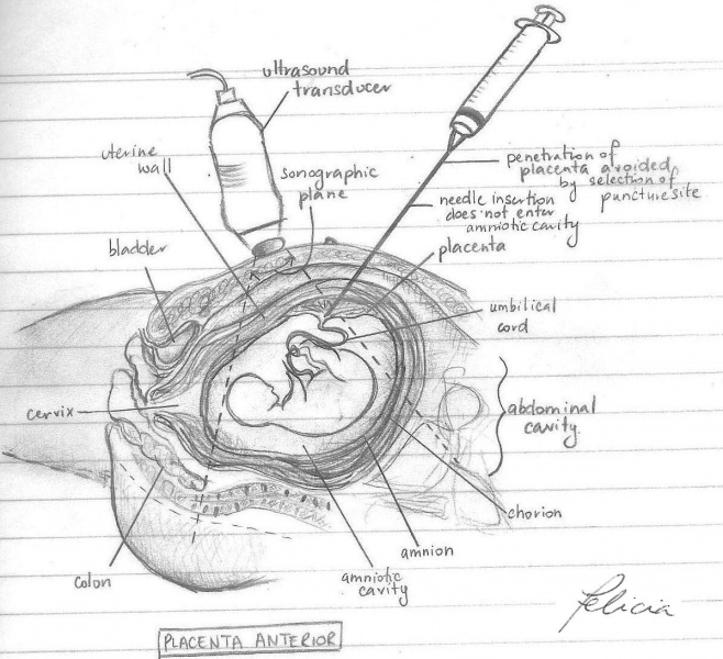 File:Placenta Anterior.jpg