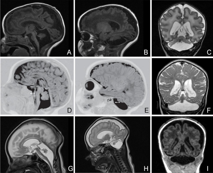 File:Pontocerebellar Hypoplasia MRI01.jpg