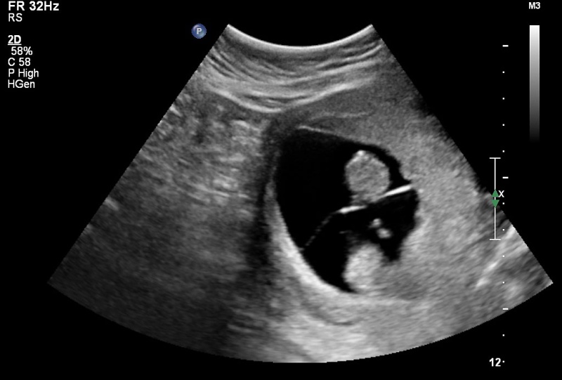 File:Ultrasound twinning 02.jpg