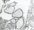 Fig. 110. Fairly late stage in the degeneration of the villous vessels in hydatiform villi. No. 977. X50.