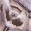 fig 43a Stenotic pulmonary valve