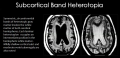 Fig 17. Observable radiographic features of subcortical band heterotopia