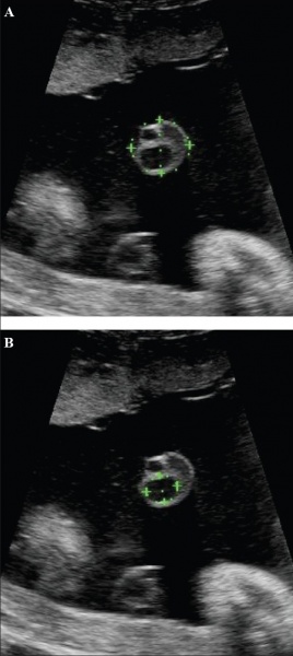 File:Placental cord ultrasound 01.jpg