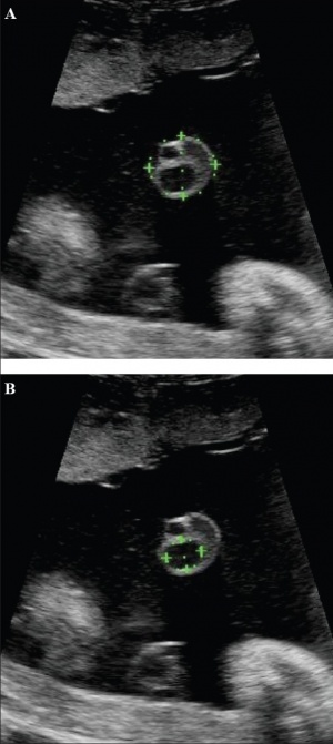 Placental cord ultrasound 01.jpg