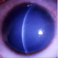Appearance of cornea due to Corneal hereditary endothelial dystrophy.