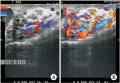 Z3463514 Color Doppler ultrasonography of varicocele. No explanation as too what the colour coding is showing in these ultrasound images. The summary information could have been expended to a complete explanation of what is shown.