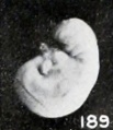 Fig. 189. A macerated, disproportional cyema 4 mm. long, showing a development of 5.5 mm. No. 786. X4.