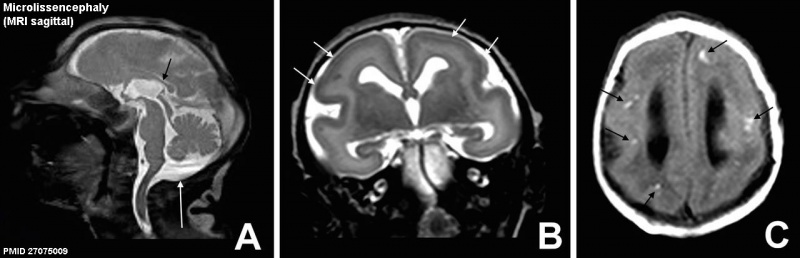 File:Microlissencephaly MRI-01.jpg