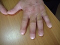 An example of finger clubbing