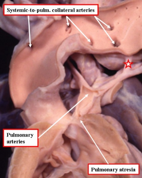 File:Tetralogy of Fallot with pulmonary atresia.jpg