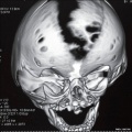 Skull vault defect and midface hypoplasia
