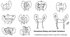 Renal System - Abnormalities - Embryology