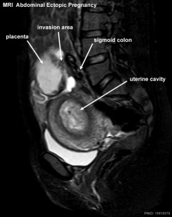 Abdominal ectopic pregnancy MRI.jpg