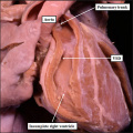 fig 11b Human ventricular septal defect