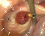 Human ovulation 02.jpg