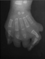 Left hand reduction defect x-ray