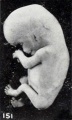 Fig. 151. Slightly macerated twin fetus. No. 1840a. X 11.35.