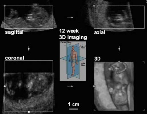 Is ultrasound gestational age accurate