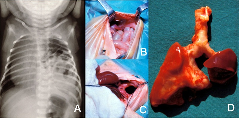 File:Congenital diaphragmatic hernia 01.jpg