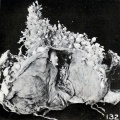 Fig. 132. The same specimen, opened in the capsular region to show the presence of the cyema. Xl.l.