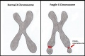 Figure 1:' Comparison between a normal X chromosome and a Fragile X chromosome