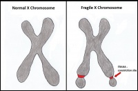 Figure 1: Comparison between a normal X chromosome and a Fragile X chromosome