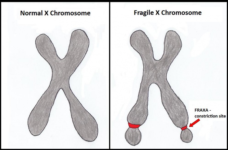 File:Fragile X Chromosome..jpg