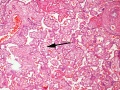 Term placenta chorangiosis