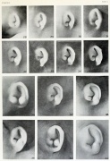 Hearing - Outer Ear Development - Embryology