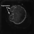 Monosomic embryo 2.jpg