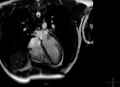 MRI of heart