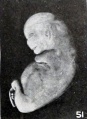 Fig. 51. Distortion due to maceration and retention in utero. No. 1931. XI.