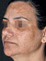 Fig 16 Mixed facial melasma