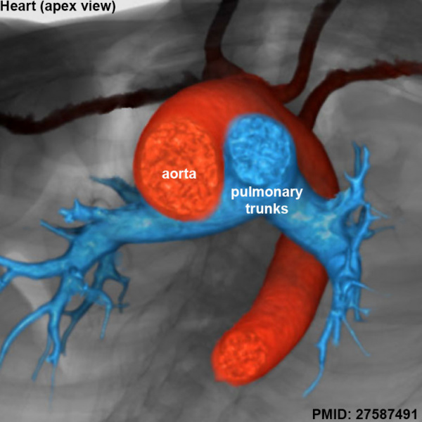 File:Adult heart outflow tract CT02.jpg