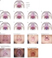 Image Shows Variations of Cleft palate/Lip]]