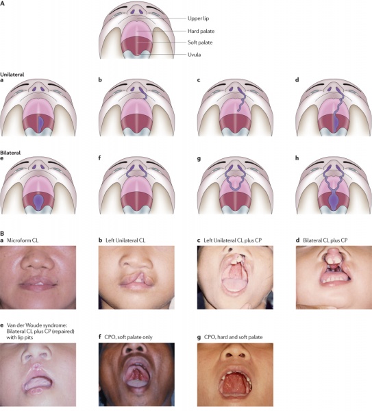 File:Variations of Cleft Lip or Palate.jpg