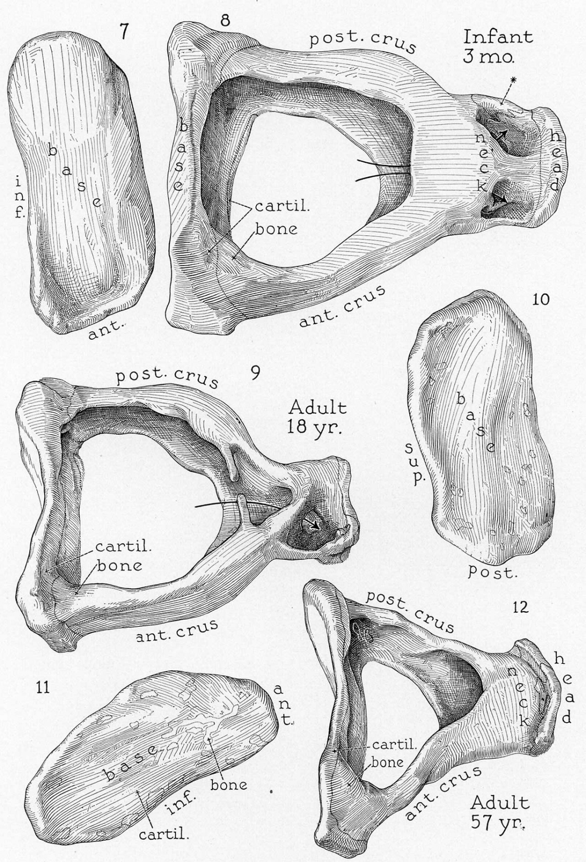 Paper - Stapes, fissula ante fenestram and associated structures in man ...