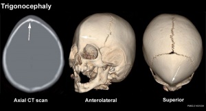 Skull CT abnormal 07.jpg