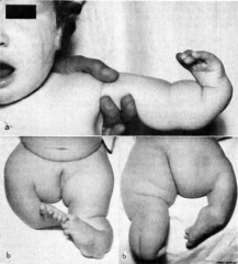 Musculoskeletal System - Limb Abnormalities - Embryology