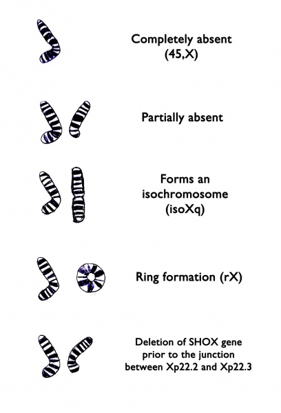 File:Turner Syndrome X Chromosome Variations.jpg