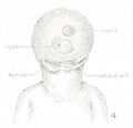 Fig. 4. Agnathia+cyclopia