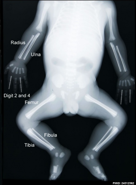 File:Fetal limb abnormalities X-ray-03.jpg