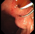 Abnormality - ectopic opening of the common bile duct (CBD) into the duodenal bulb.