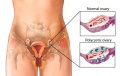 Comparison of Normal and Polycystic Ovary