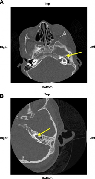 File:MRI of Goldenhar Syndrome.jpg