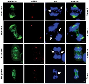 Chromosome segregation defects associated with abnormal spindles in UBE3A shRNA knockdown clones.jpg