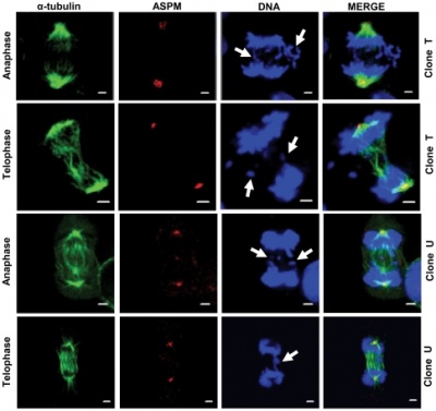 Chromosome segregation defects associated with abnormal spindles in UBE3A shRNA knockdown clones.jpg