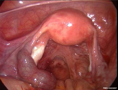 Ectopic molar pregnancy 01.jpg